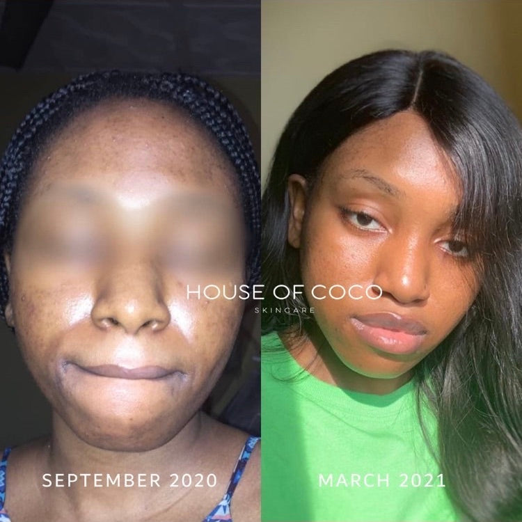 750px x 750px - 04- TOTAL TRANSFORMATION! â€“ Page 2 â€“ House of Coco Skincare